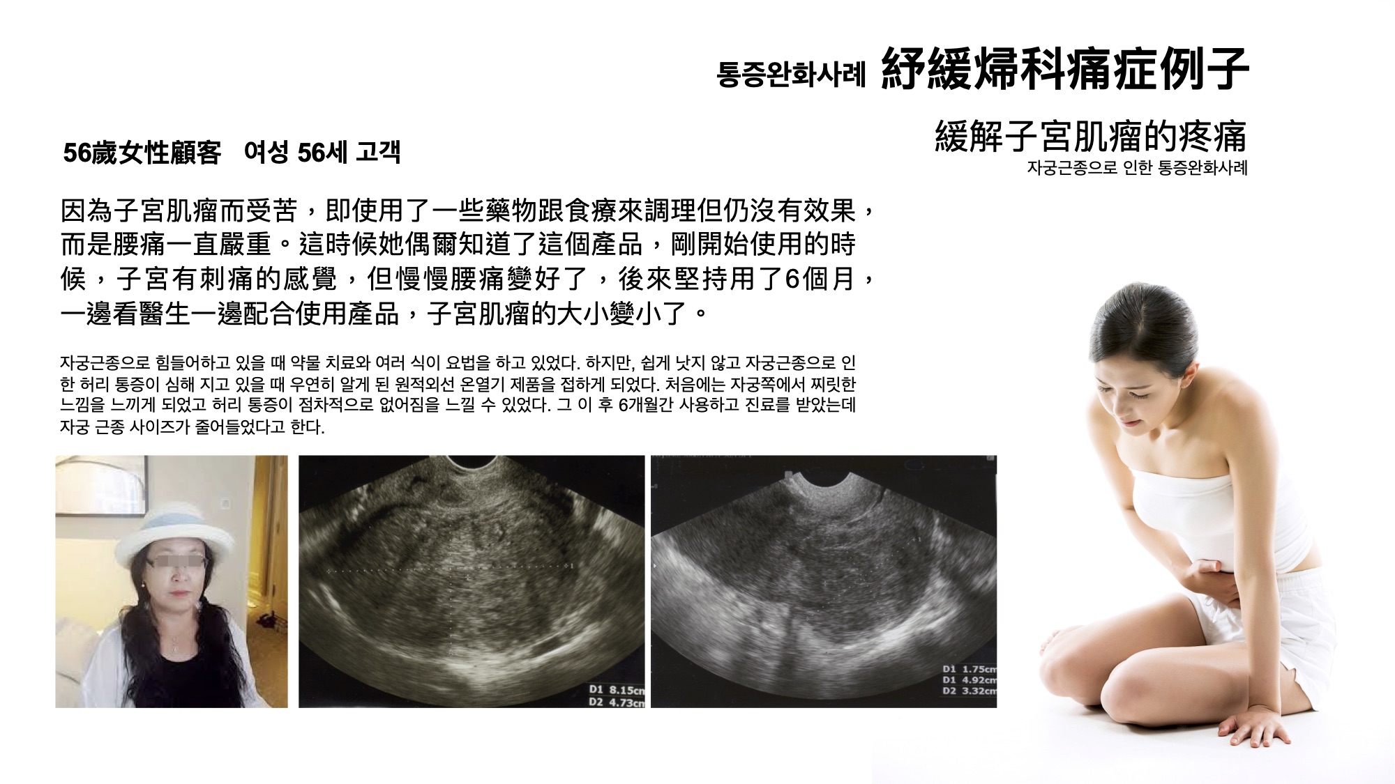 因為子宮肌瘤而受苦，即使用了⼀些藥物跟食療來調理但仍沒有效果， 而是腰痛⼀直嚴重。這時候她偶爾知道了這個產品，剛開始使⽤的時 候，子宮有刺痛的感覺，但慢慢腰痛變好了，後來堅持⽤了6個月， ⼀邊看醫⽣⼀邊配合使用產品，子宮肌瘤的⼤小變小了。